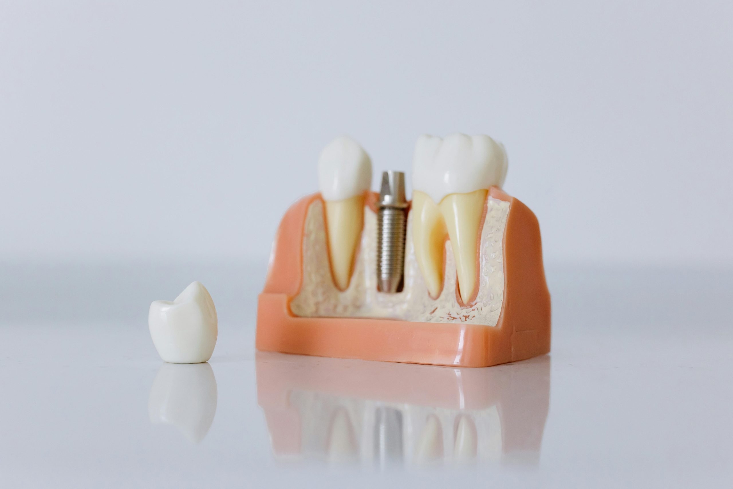 Dental implants