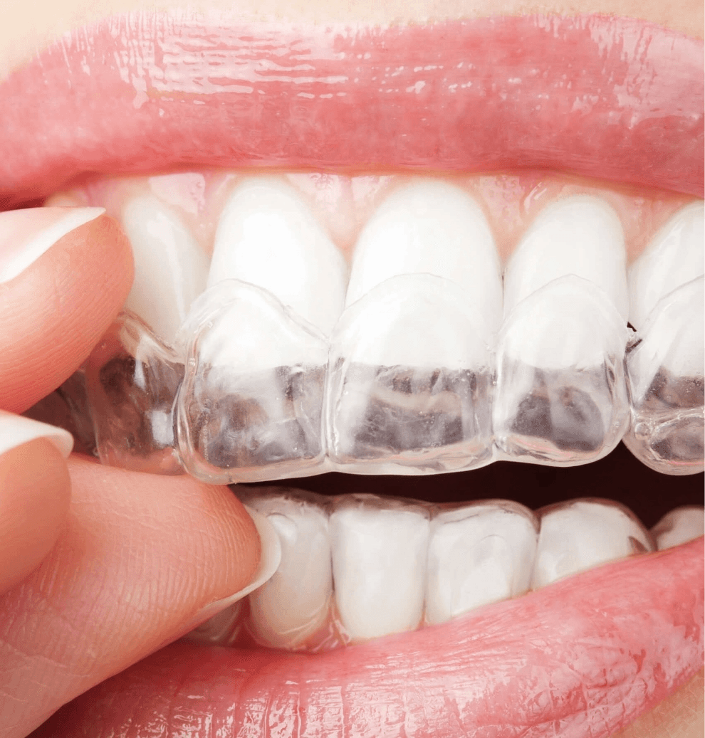 A woman putting the Aligners into her mouth and over her teeth