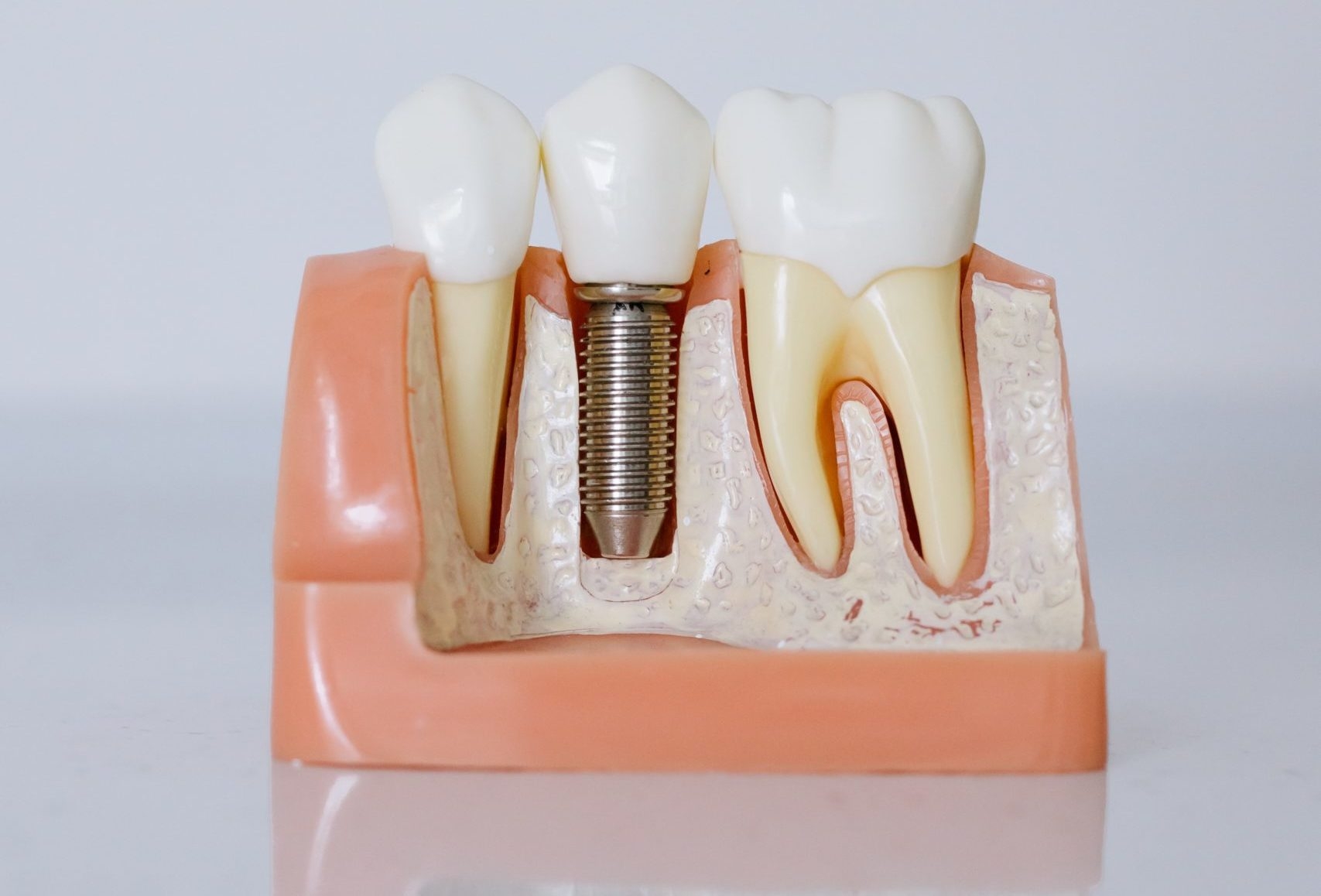 Dental Implant