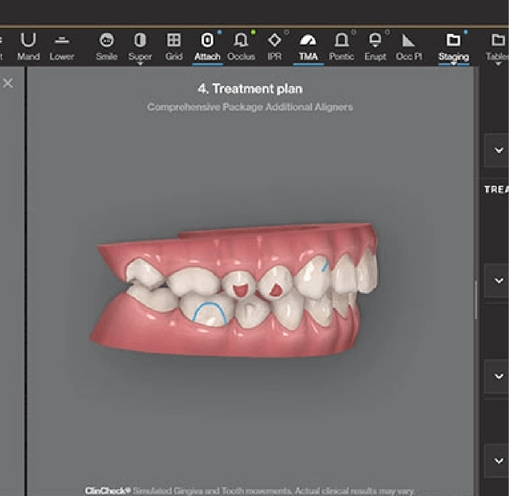 A 3D mould of top and bottom rows of teeth